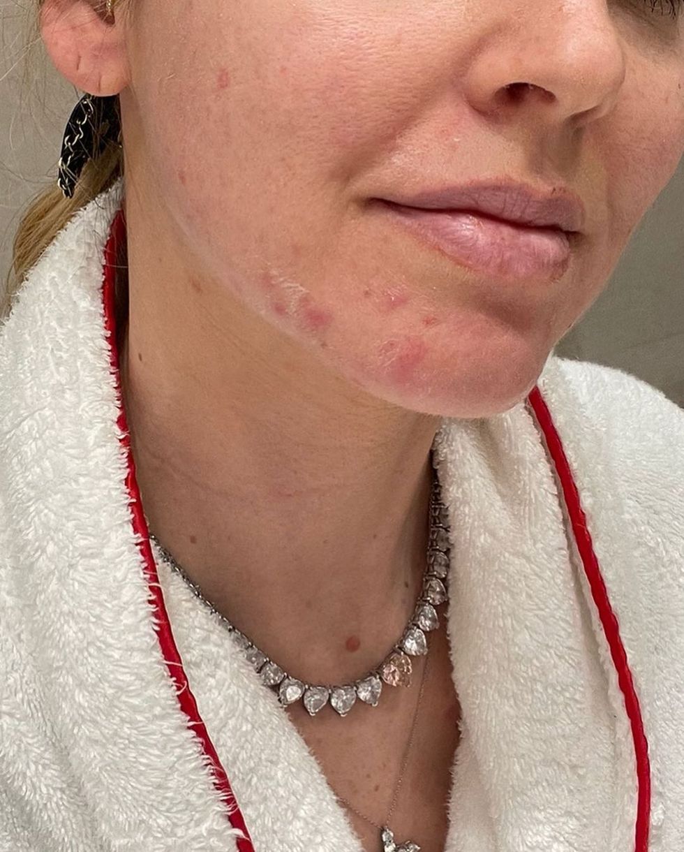 chiara ferragni mostra l'acne su instagram «non dobbiamo avere la pressione di sentirci sempre perfetti»