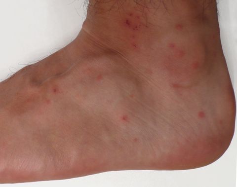 what do chigger bites look like
