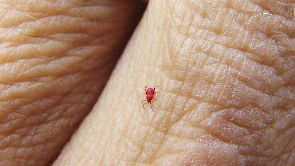 What Do Chigger Bites Look Like? How To Get Rid Of Berry, 48% OFF