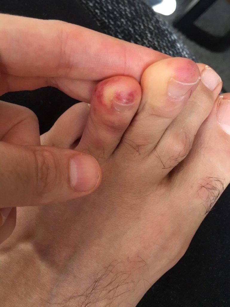 covid toes, or chilblains