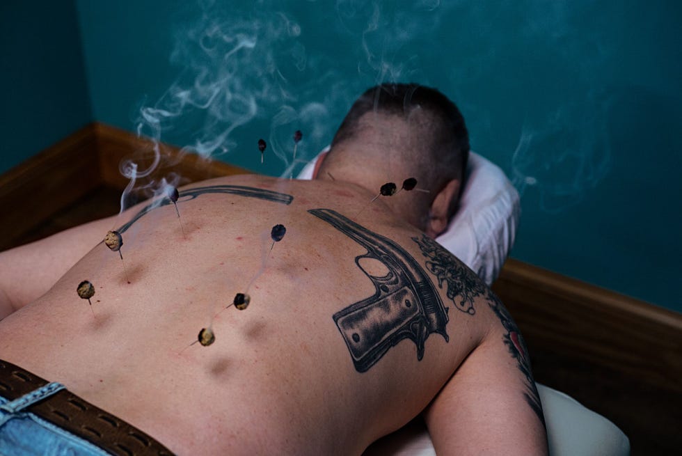 n een kliniek in Beckley West Virginia krijgt Jeff Hendricks acupunctuur en moxatherapie tegen pijn die hij heeft overgehouden aan zijn vier jaar militaire dienst Hij heeft hersenletsel uitpuilende nekwervels hielspoor hoofdpijn gevoelloze handen en PTSS Door de behandeling heeft hij minder behoefte aan reguliere medicijnen