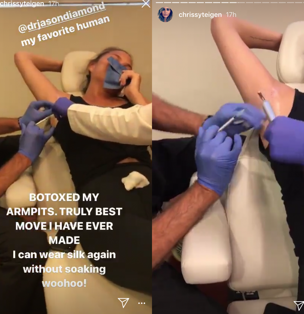 chrissy teigen armpit botox instagram