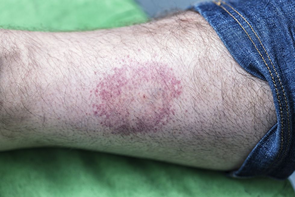 Man Bitten by Spider As He Slept Left in Immense Pain, Covered in Rash