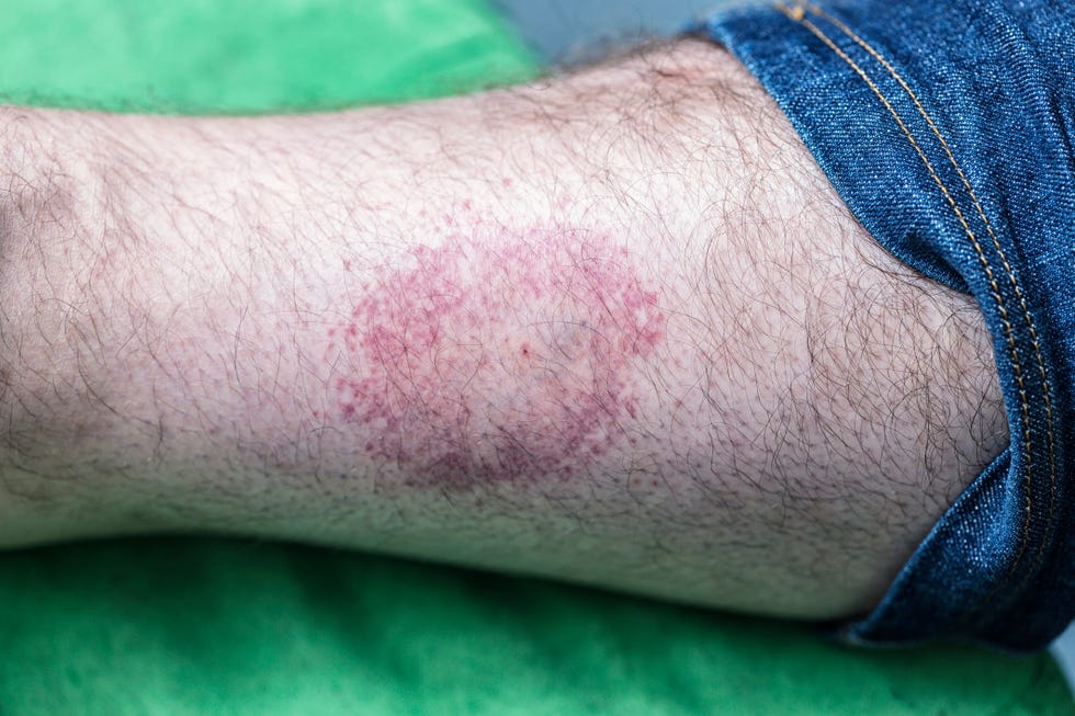 Man Bitten by Spider As He Slept Left in Immense Pain, Covered in Rash