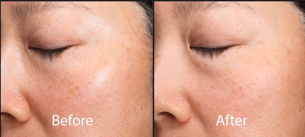 comparison of skin appearance before and after treatment