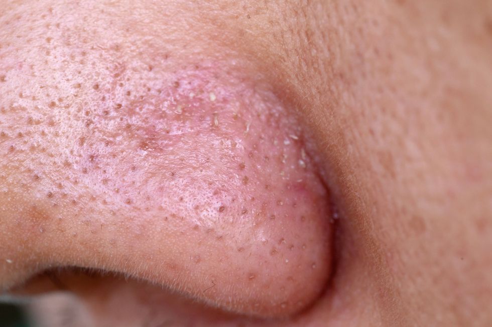 close up blackheads on the nose