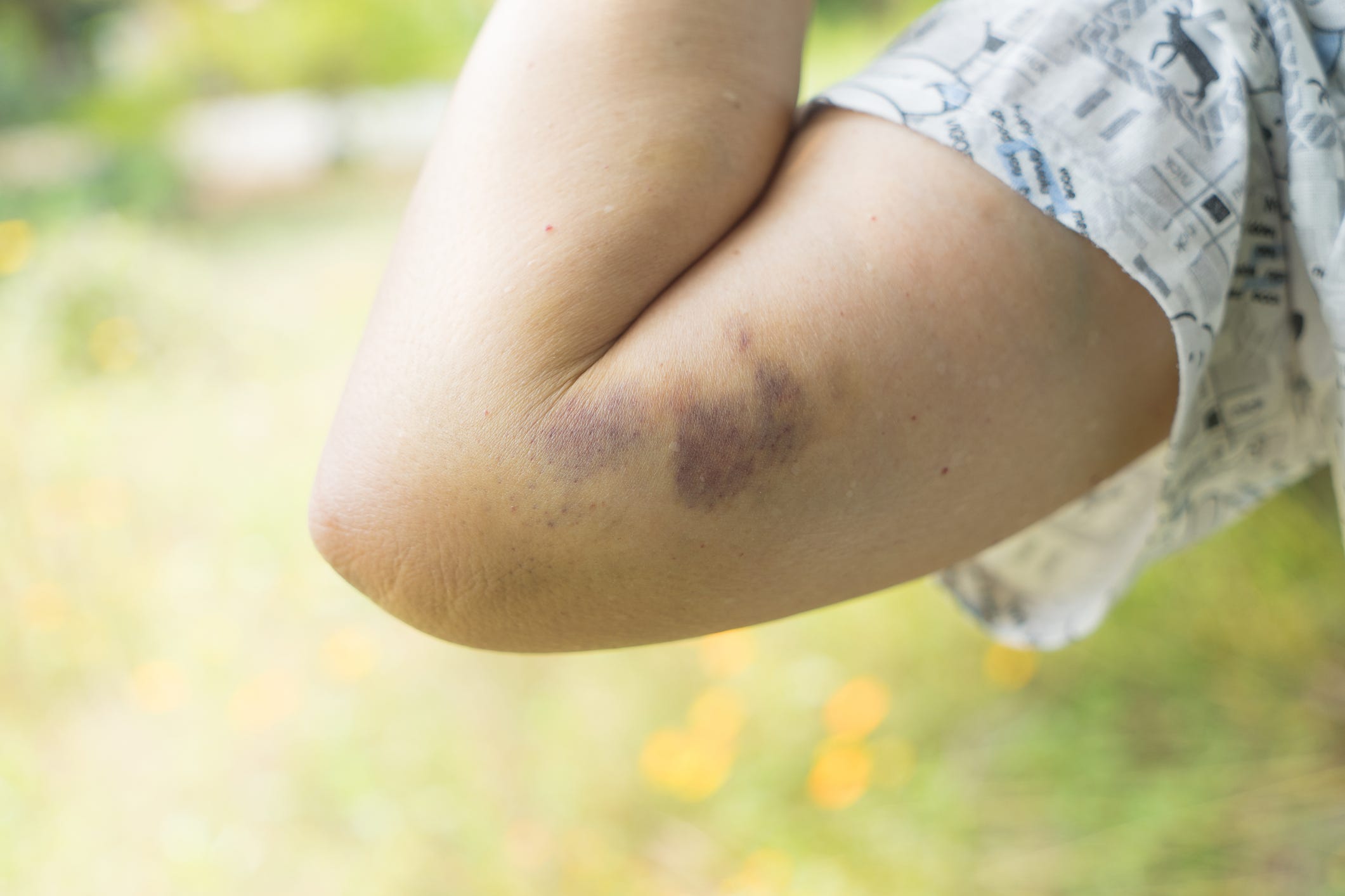 Eczema Types Of Bruises