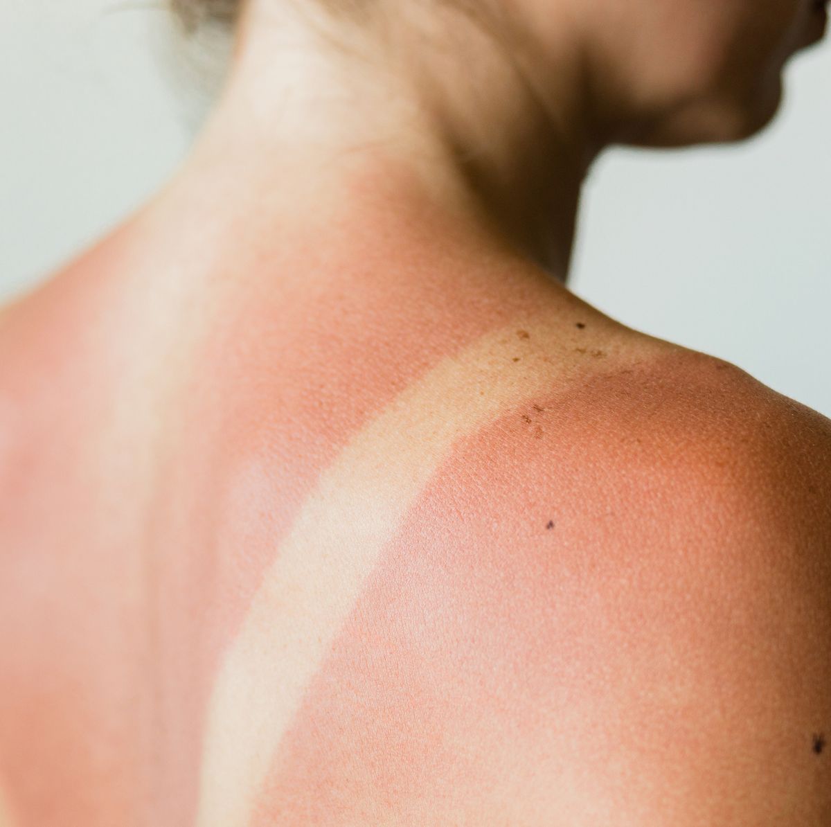 Treating a Sunburn with Home Remedies