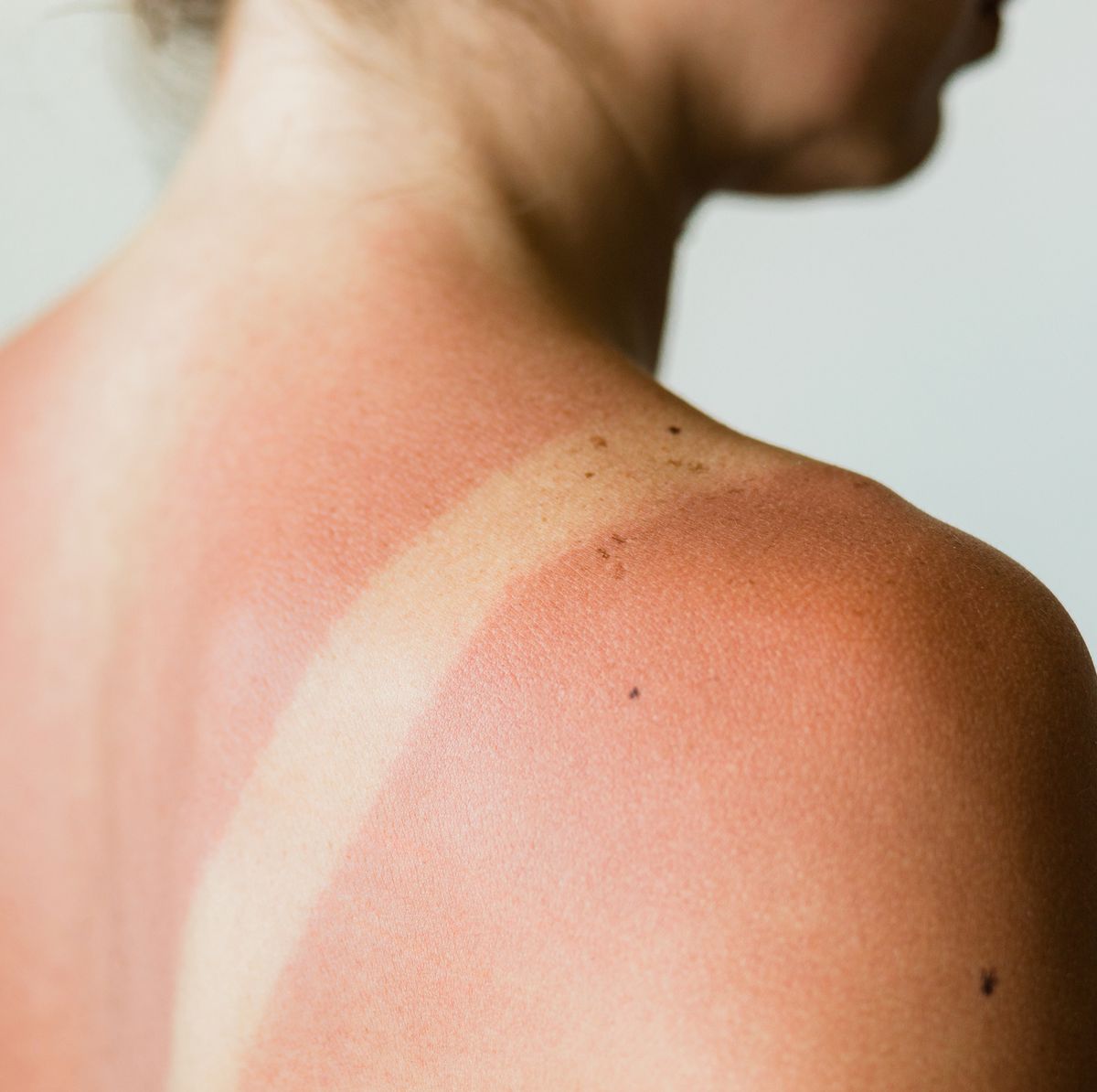 2 Powerful Natural Remedies For Sunburns