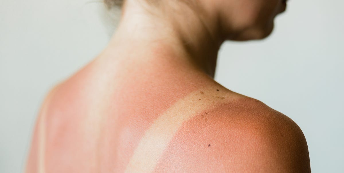 12 Best Home Remedies for Sunburn - How to Get Rid of Skin Burn