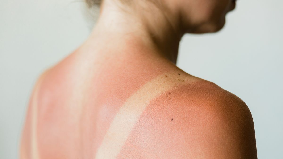 10 Natural Ways to Soothe a Sunburn
