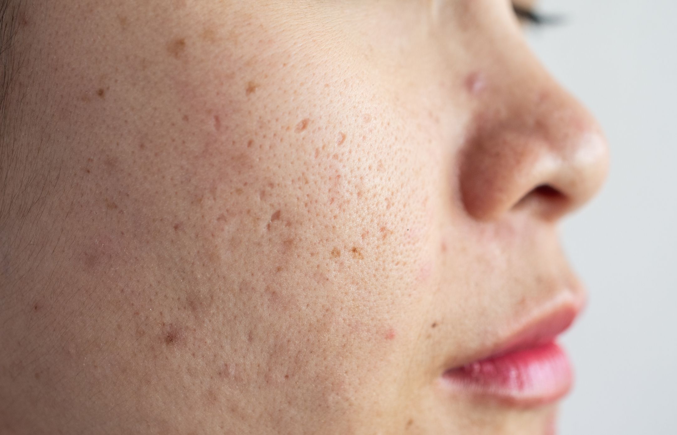 Close up of Asian woman face has problems with aging skin/acne scar on her face.