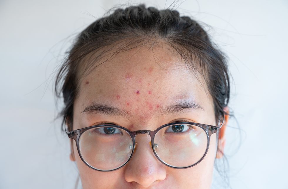 close up of asian woman with pimple and acne inflamed on her forehead