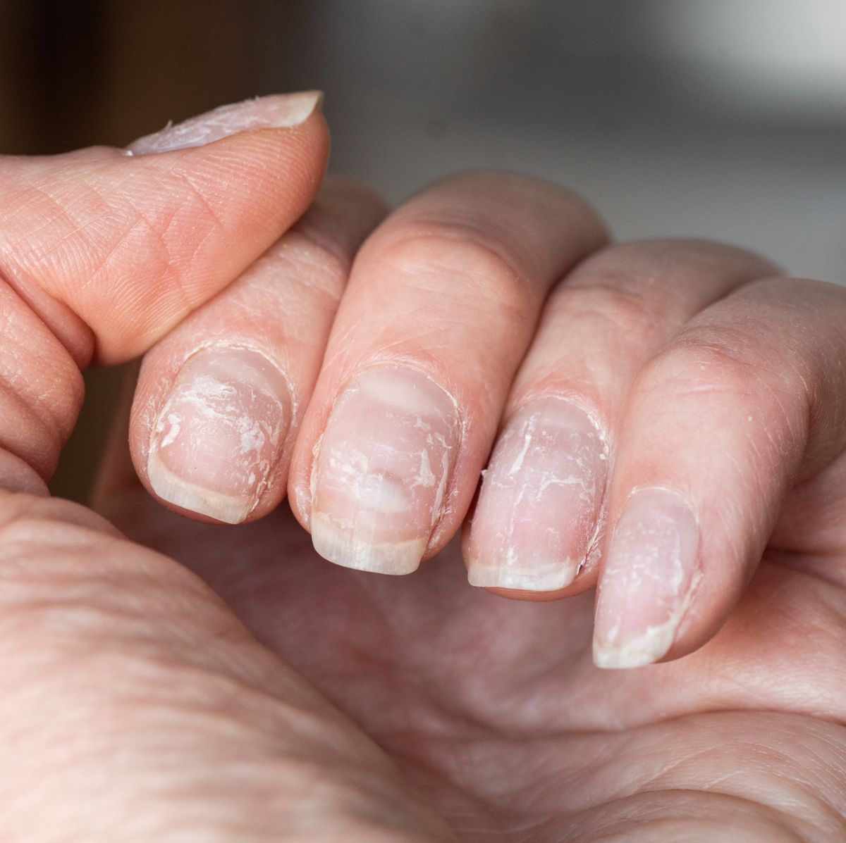 Why Are My Nails Peeling? - 7 Causes of Flaking, Peeling Nails