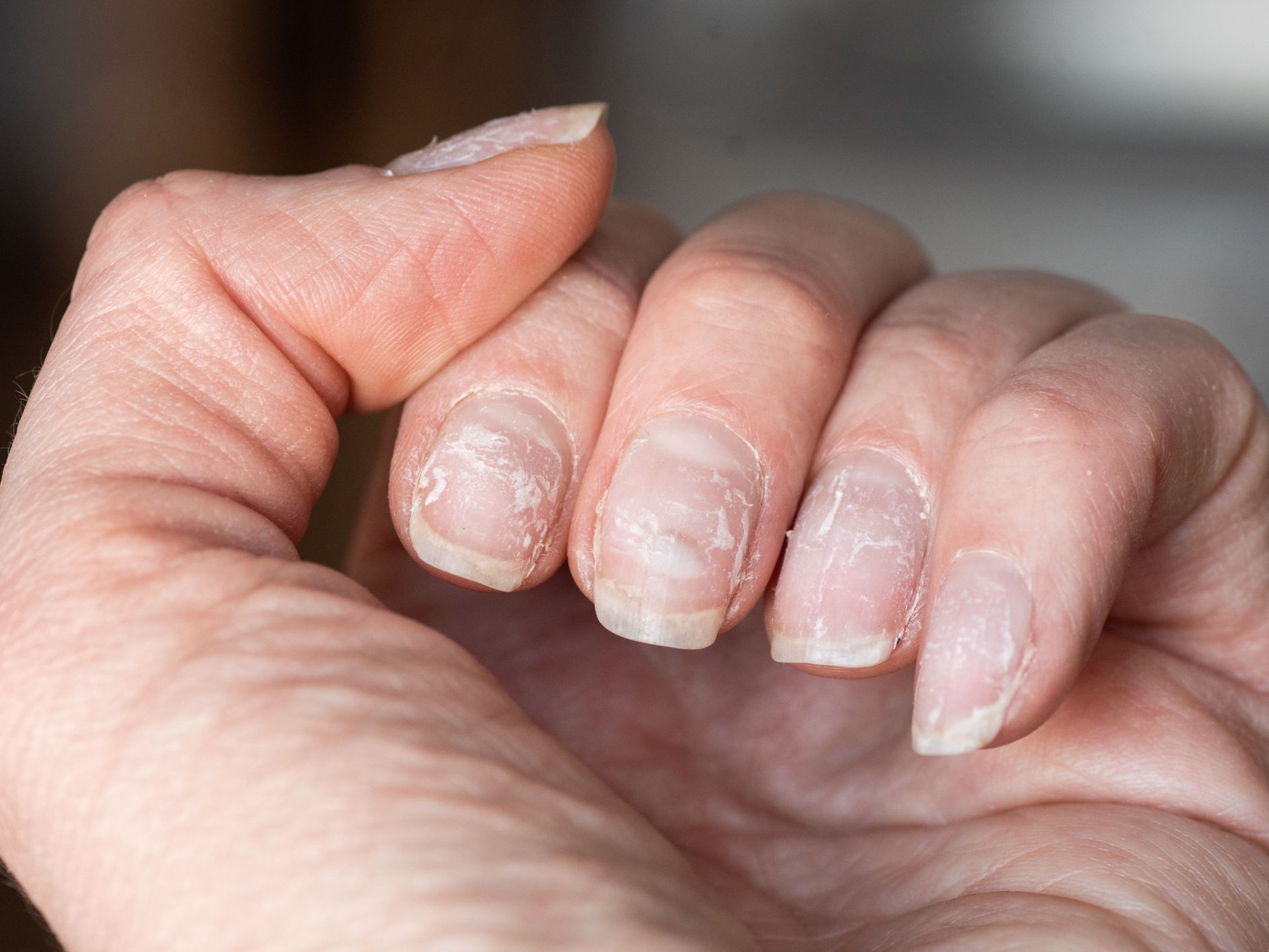 finger nail damage