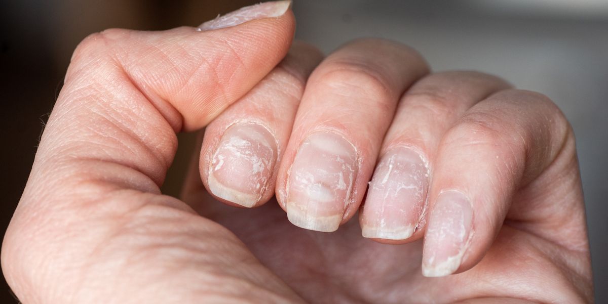 8 Reasons Why Your Nails Are Peeling and How to Fix It