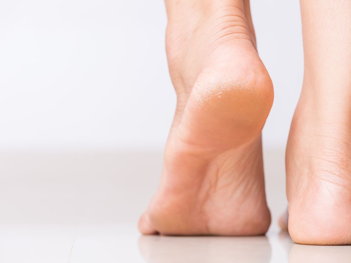 The Best Callus Remover—And Six Other Ways to Deal With Calluses