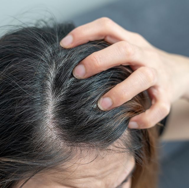 close up of dandruff problem on woman head dandruff is a skin condition that causes itchy