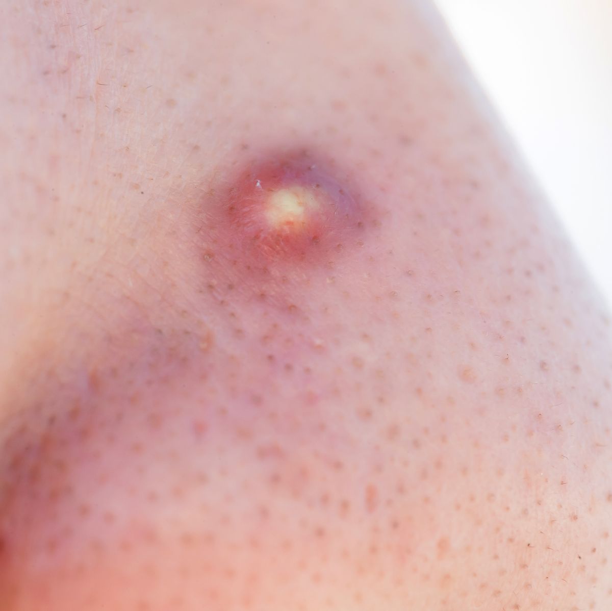 The 10 Most Satisfying Pimple Popping Videos Of