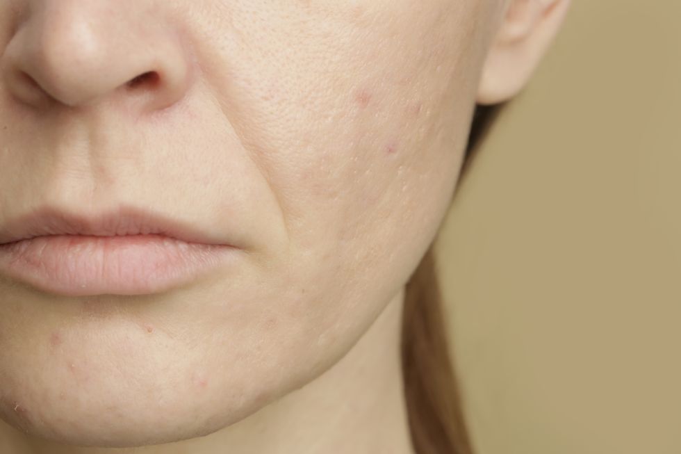 close up of female face problematic sensitive skin with large pores, redness and acne
