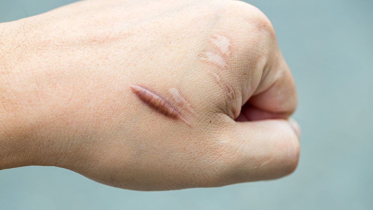 How to Get Rid of Scars - Dermatologist Tips on How to Remove Old Scars