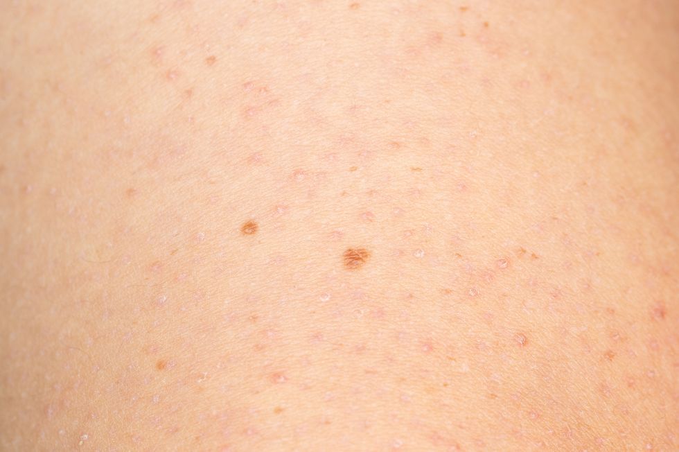 close up of keratosis pilaris on the arm of a young caucasian man
