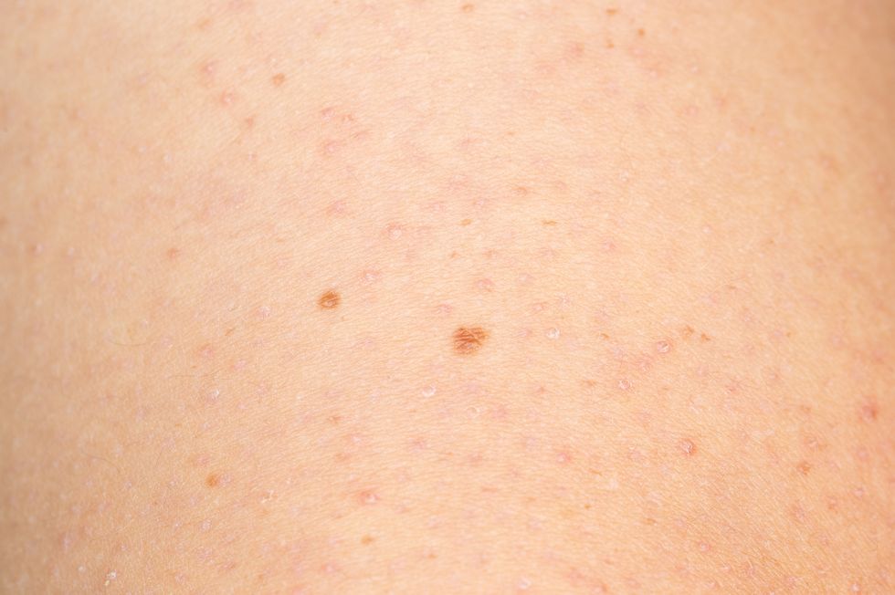 Close up of keratosis pilaris on the arm of a young caucasian man
