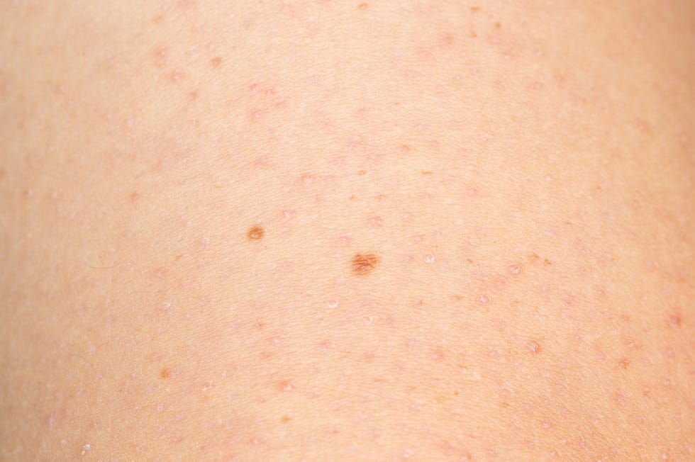 close up of keratosis pilaris on the arm of a young caucasian man