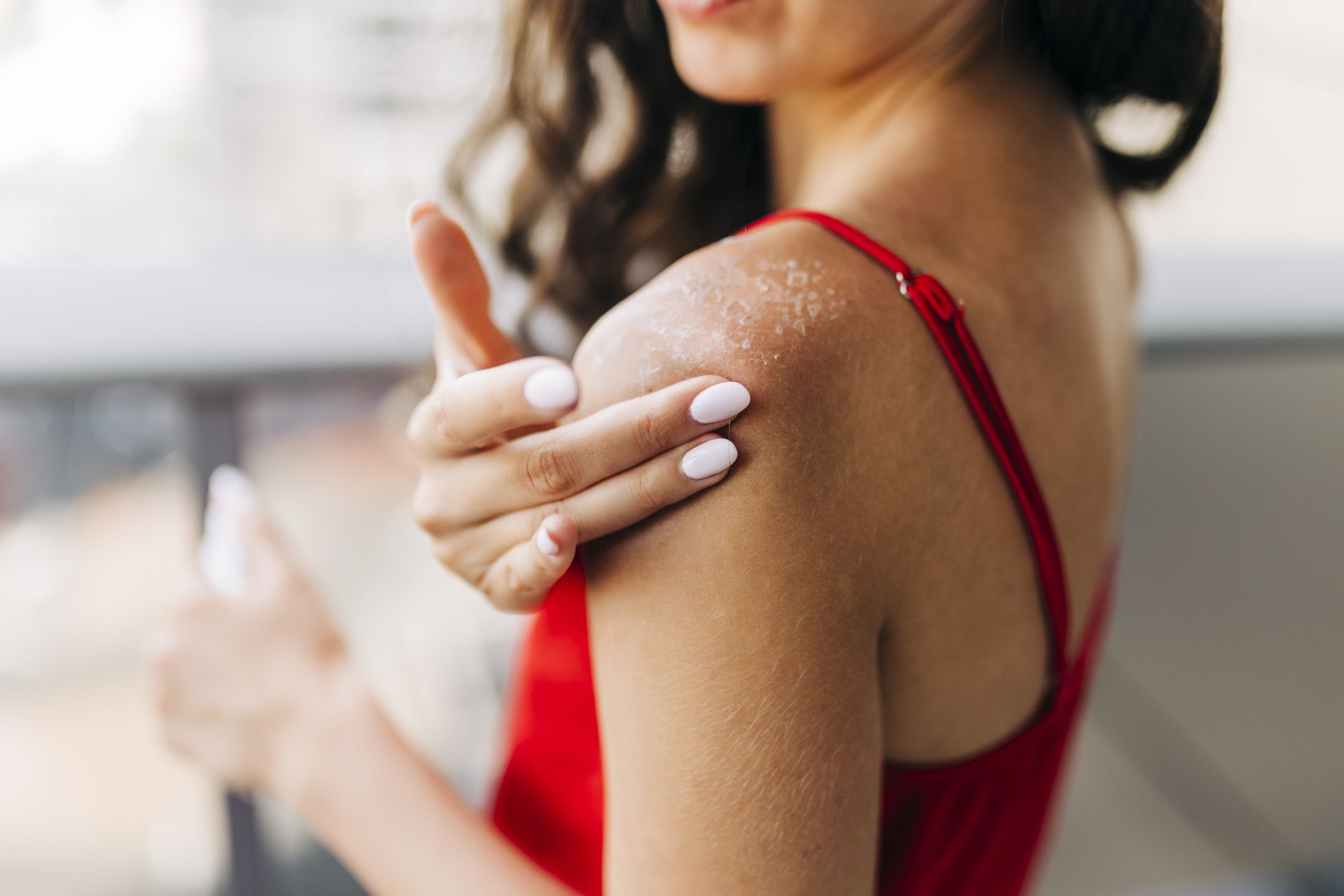Heat rash, prickly heat, dermatitis and eczema can cause summer