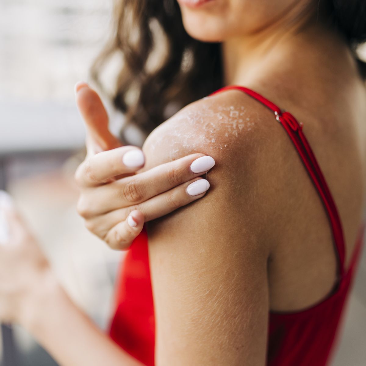 How to get rid of heat rash: Relieve redness and itchiness by doing this
