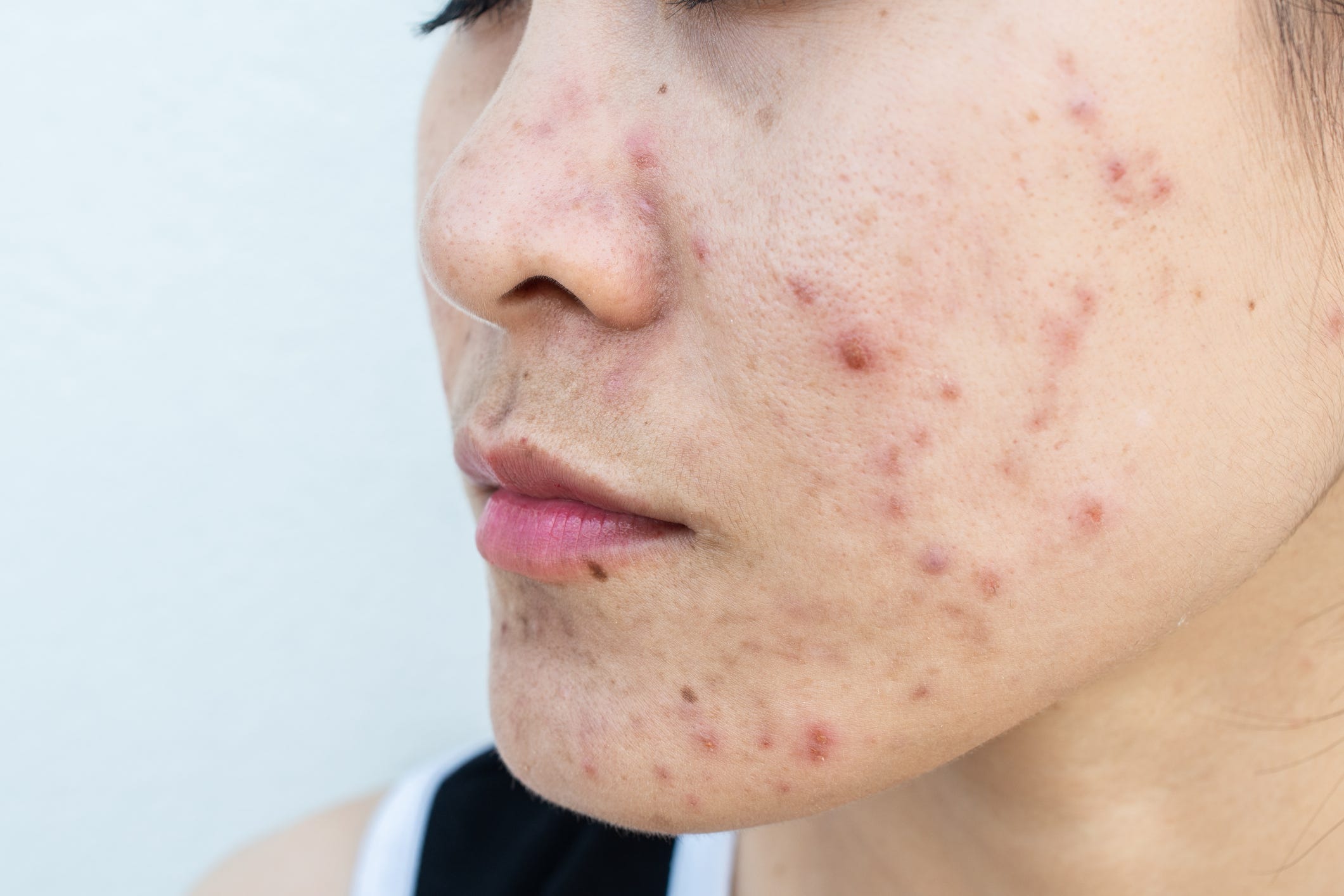 anxiety rash on face