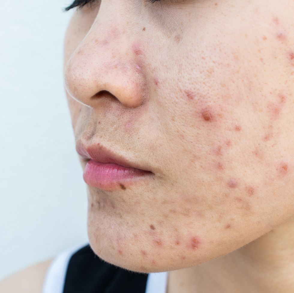 close up of woman face has variety problems on her skin such as acne, pimple, pores and melasma etc