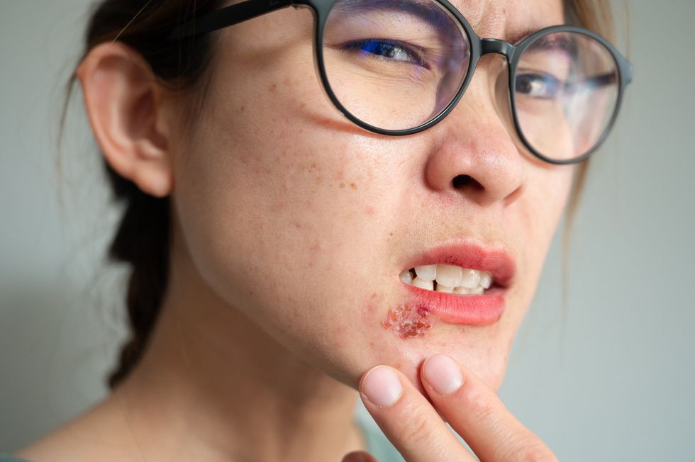 close up of woman feeling pain from herpes labialis occur on her lower lip
