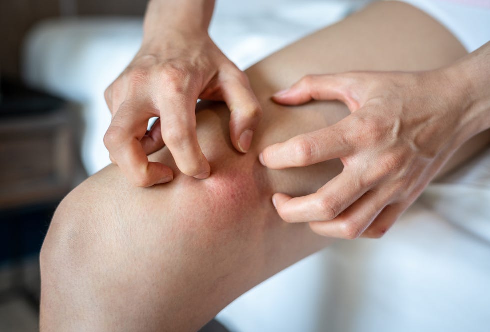 close up of woman having itch caused of a red rash on her thigh