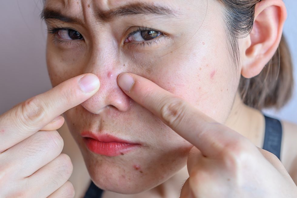 close up of woman pointing a problem on her face with variety problems on her skin such as acne, pimple, pores and melasma etc