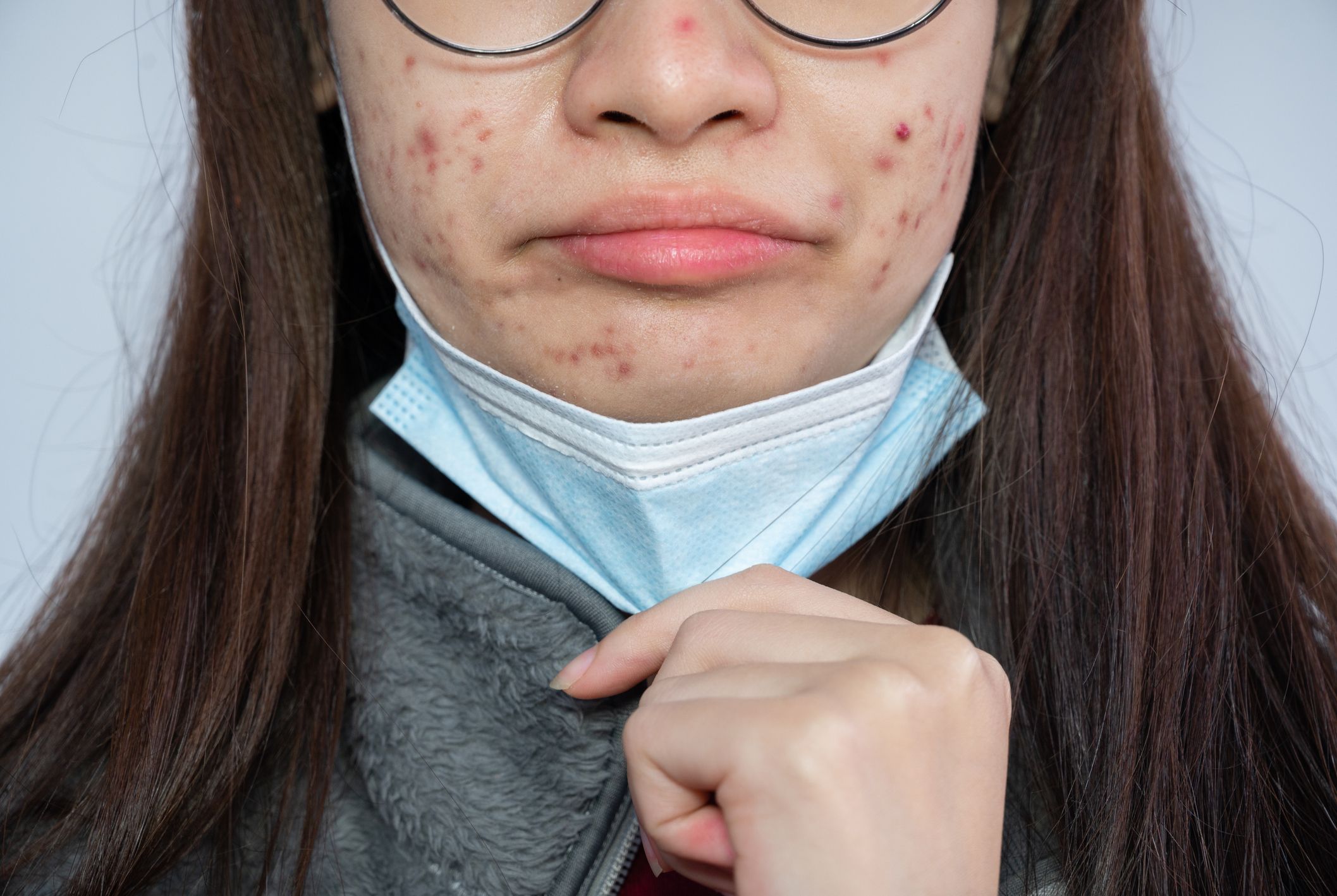 chin breaking out from wearing mask