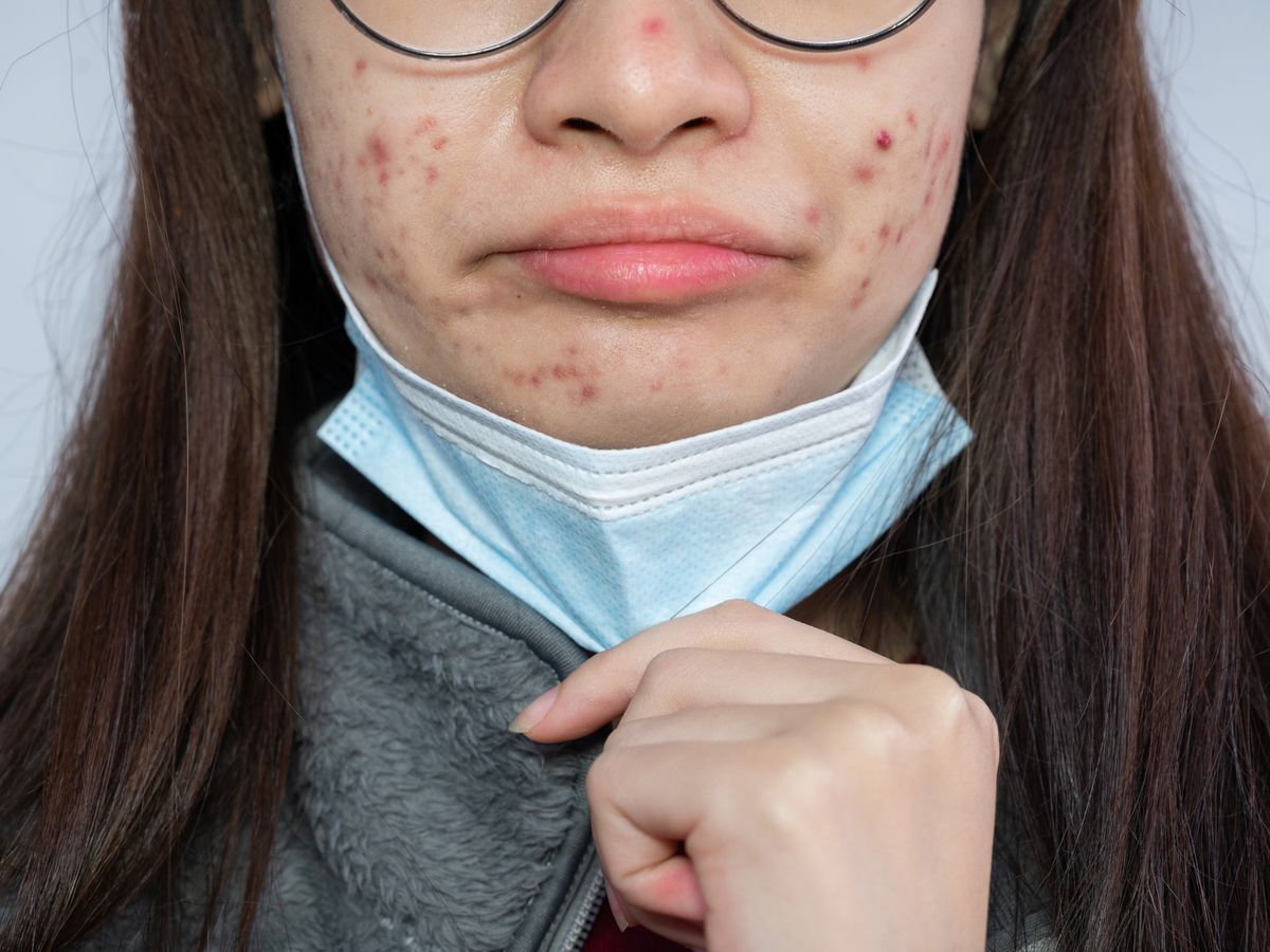 Mask-related Acne Tips from a Dermatologist