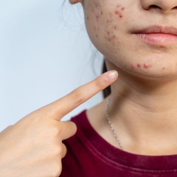 close up of young worried asian woman pointing to acne inflamed on her face