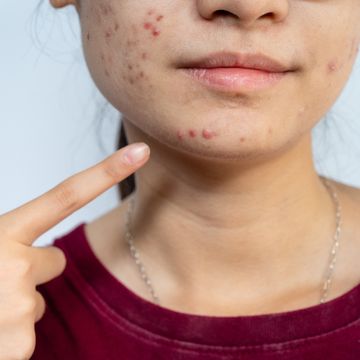 close up of young worried asian woman pointing to acne inflamed on her face