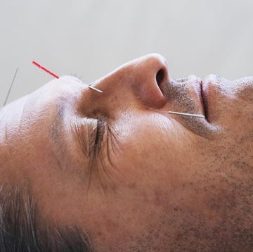 close up portrait of a man having acupuncture on his face
