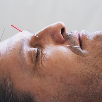 close up portrait of a man having acupuncture on his face