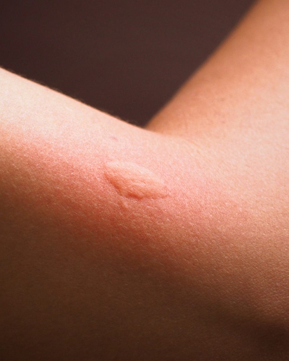 close up red spot swollen and allergies from mosquito bites on woman arm after mosquito insect sucking blood on skin danger of mosquito concept