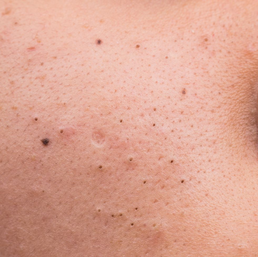 closed up of pimple blackheads on face