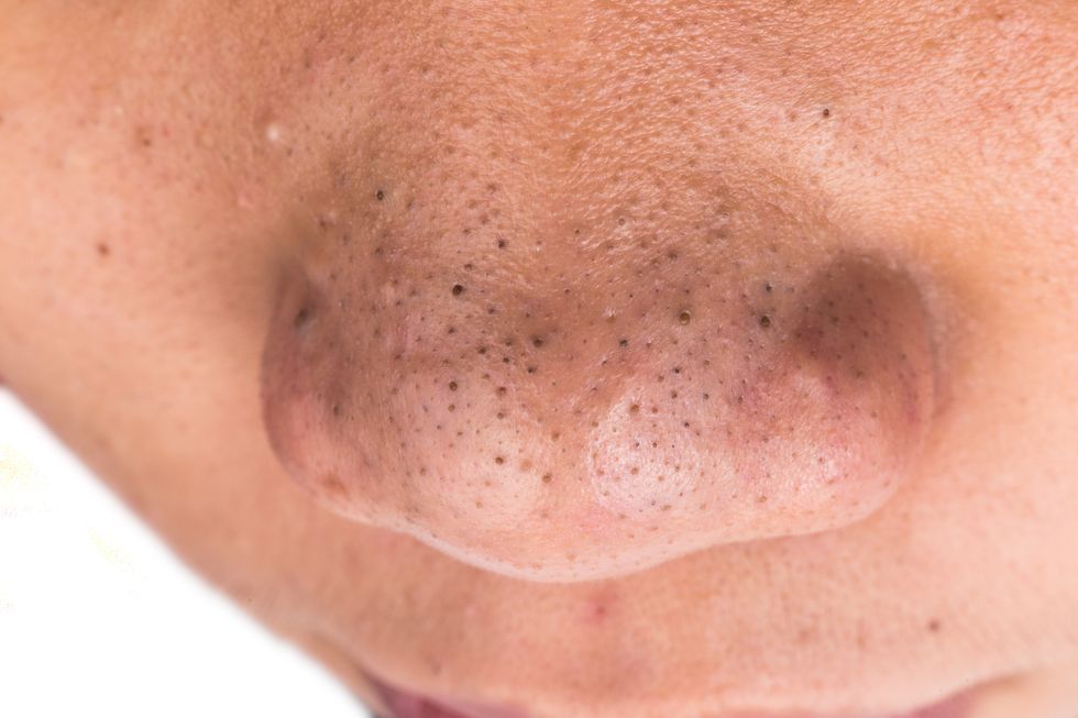 closed up of pimple blackheads on the nose