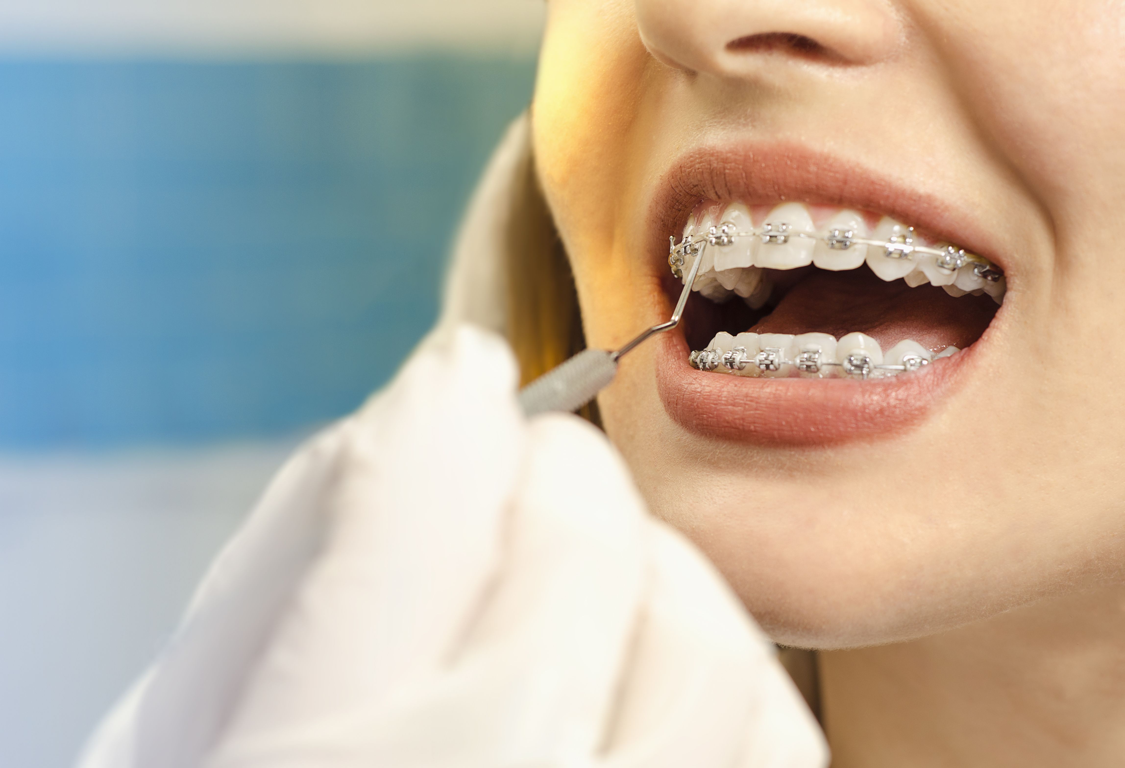 Can You Wear Braces on Your Top Teeth Only?
