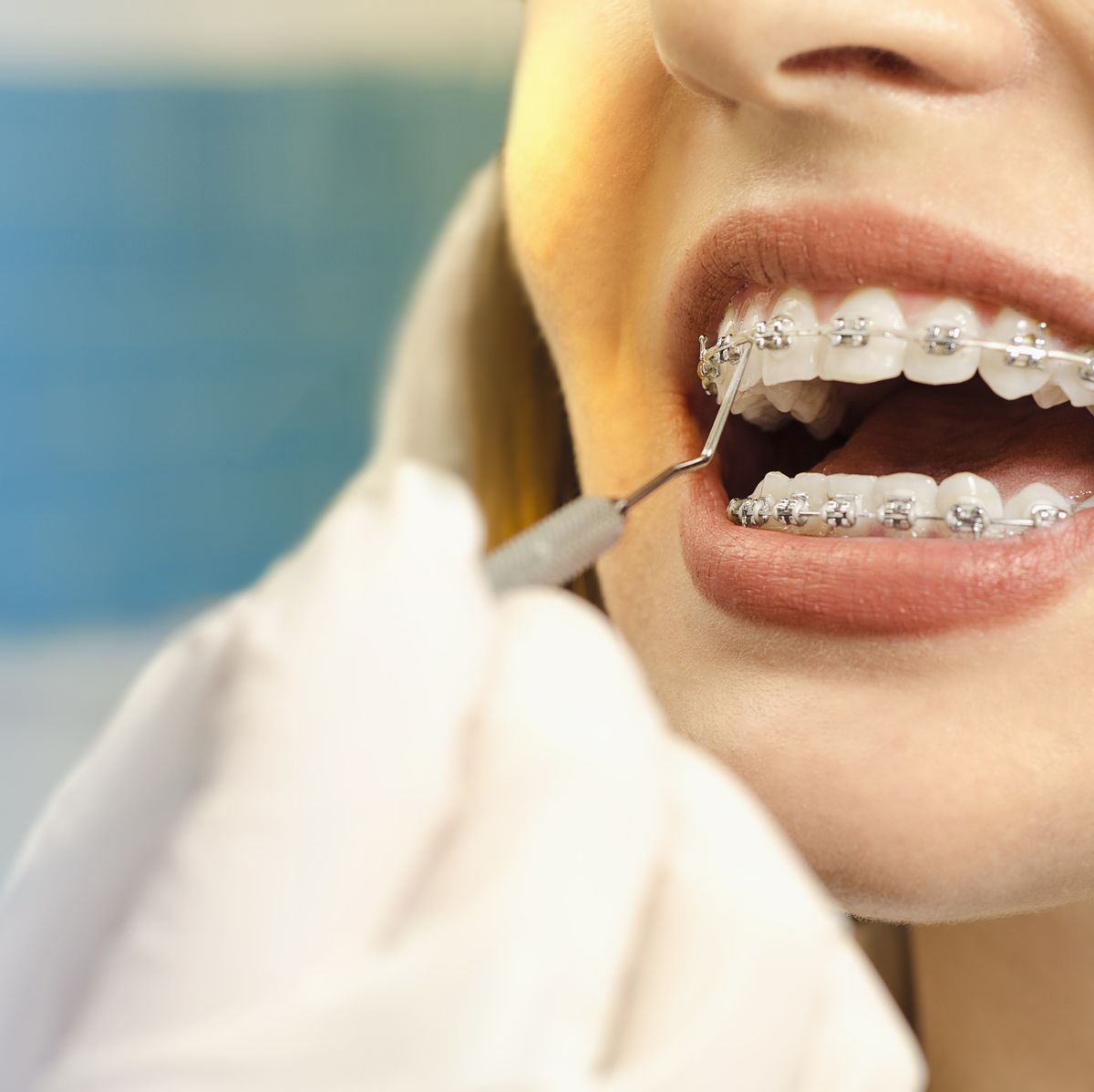 Types of Dental Braces - How & Who Makes Them?