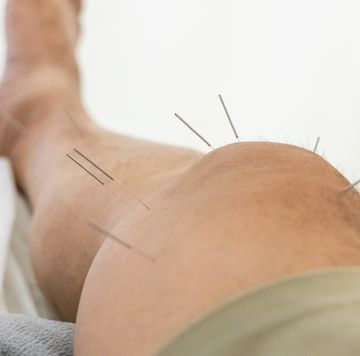 closeup of acupuncture needles on thigh of chinese man during acupuncture treatment