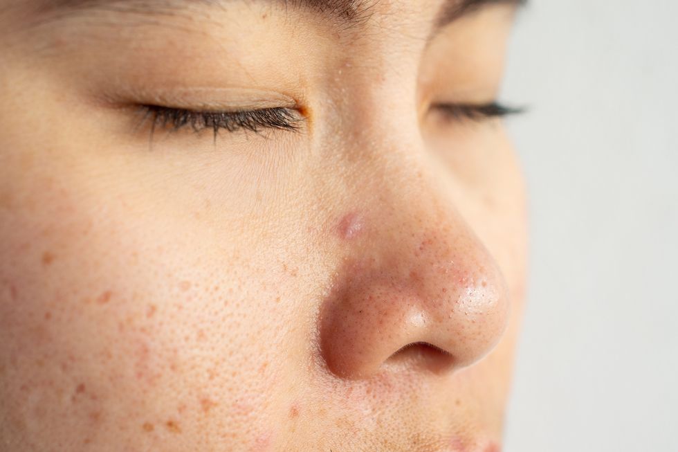 closeup of woman face with problems of acne inflammation papule and pustule on her face