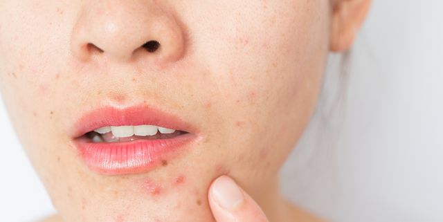 Closeup of woman half face with problems of acne inflammation (Papule and Pustule) on her face.