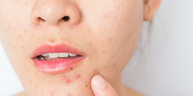 Closeup of woman half face with problems of acne inflammation (Papule and Pustule) on her face.